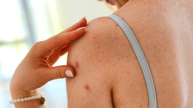 consejos-para-no-tener-acne-en-la-espalda-478ff