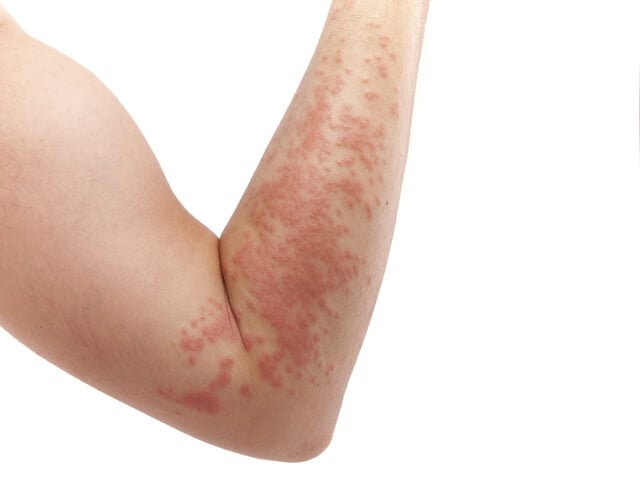 skin-allergy-rash
