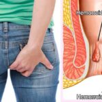 ¿ QUE SON LAS HEMORROIDES?