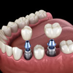 ¿ CUANDO ES RECOMENDABLE USAR IMPLANTES  DENTALES?